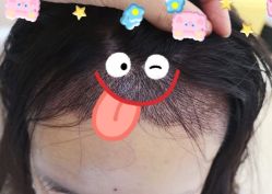 -大麦微针植发全国连锁