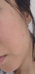 体验后-爱莎扁平疣·汗管瘤·斑痣中心