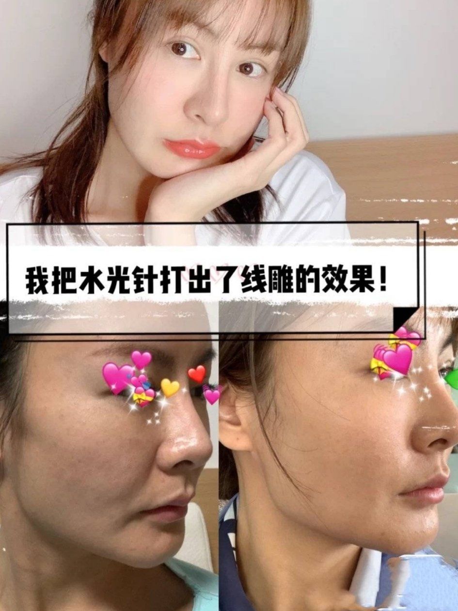 震惊到自己:有针水光打出线雕的效果!