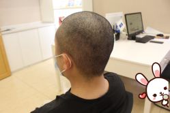 -大麦微针植发丨全国连锁