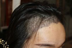 -大麦微针植发丨全国连锁