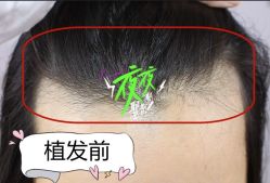 -大麦微针植发全国连锁