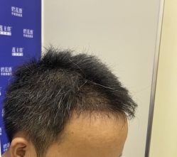 -碧莲盛·不剃发植发