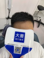 点击看大图 体验后-大麦微针植发全国连锁