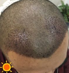 -大麦微针植发丨全国连锁