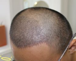 -大麦微针植发丨全国连锁