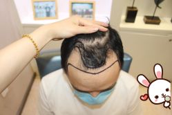 -大麦微针植发丨全国连锁