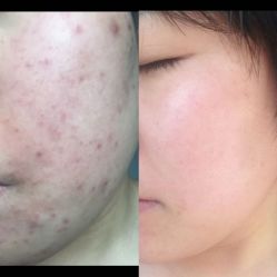 -安那般那皮肤年轻化ANAPANA