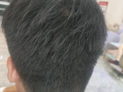 -碧莲盛·不剃发植发
