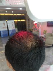 -碧莲盛·不剃发植发