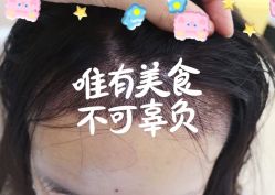 -大麦微针植发全国连锁