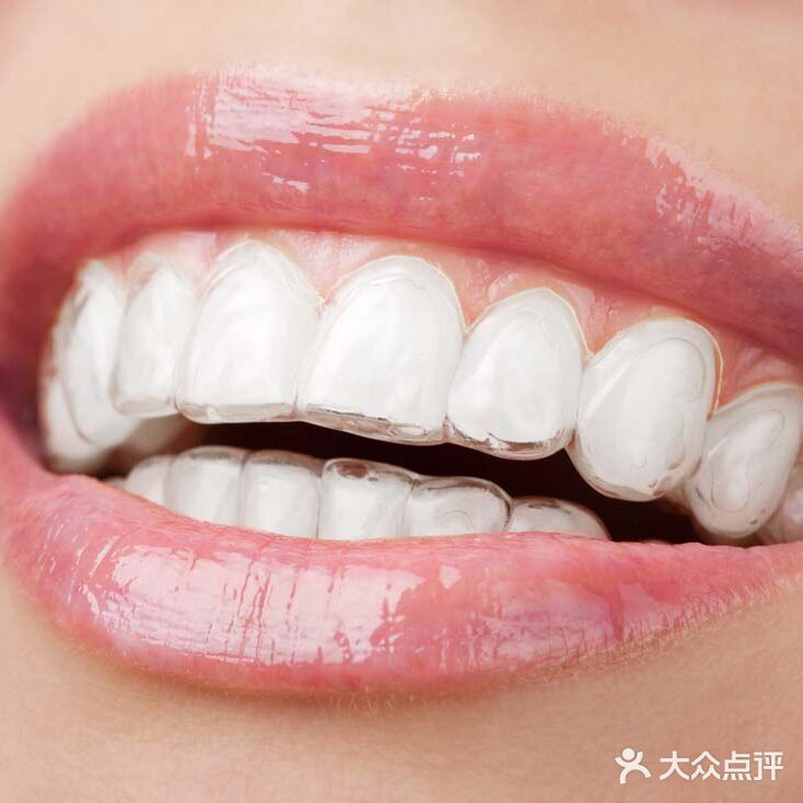 【科普】佩戴隐形牙套的注意事项