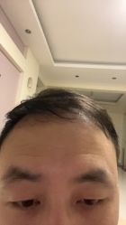 -大麦微针植发全国连锁