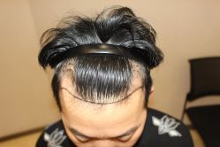 -大麦微针植发丨全国连锁