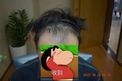 体验前-大麦微针植发全国连锁