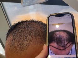 -碧莲盛·不剃发植发