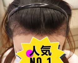 -大麦微针植发丨全国连锁