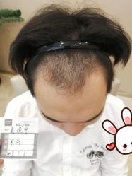 -大麦微针植发丨全国连锁