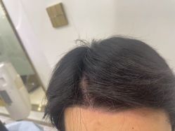 -碧莲盛·不剃发植发