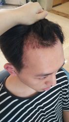 -大麦微针植发丨全国连锁