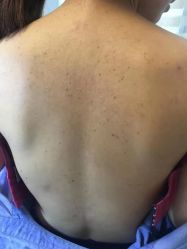 -爱莎扁平疣·汗管瘤·斑痣中心