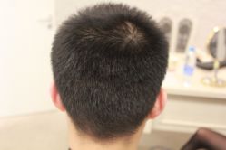 点击看大图 -大麦微针植发丨全国连锁