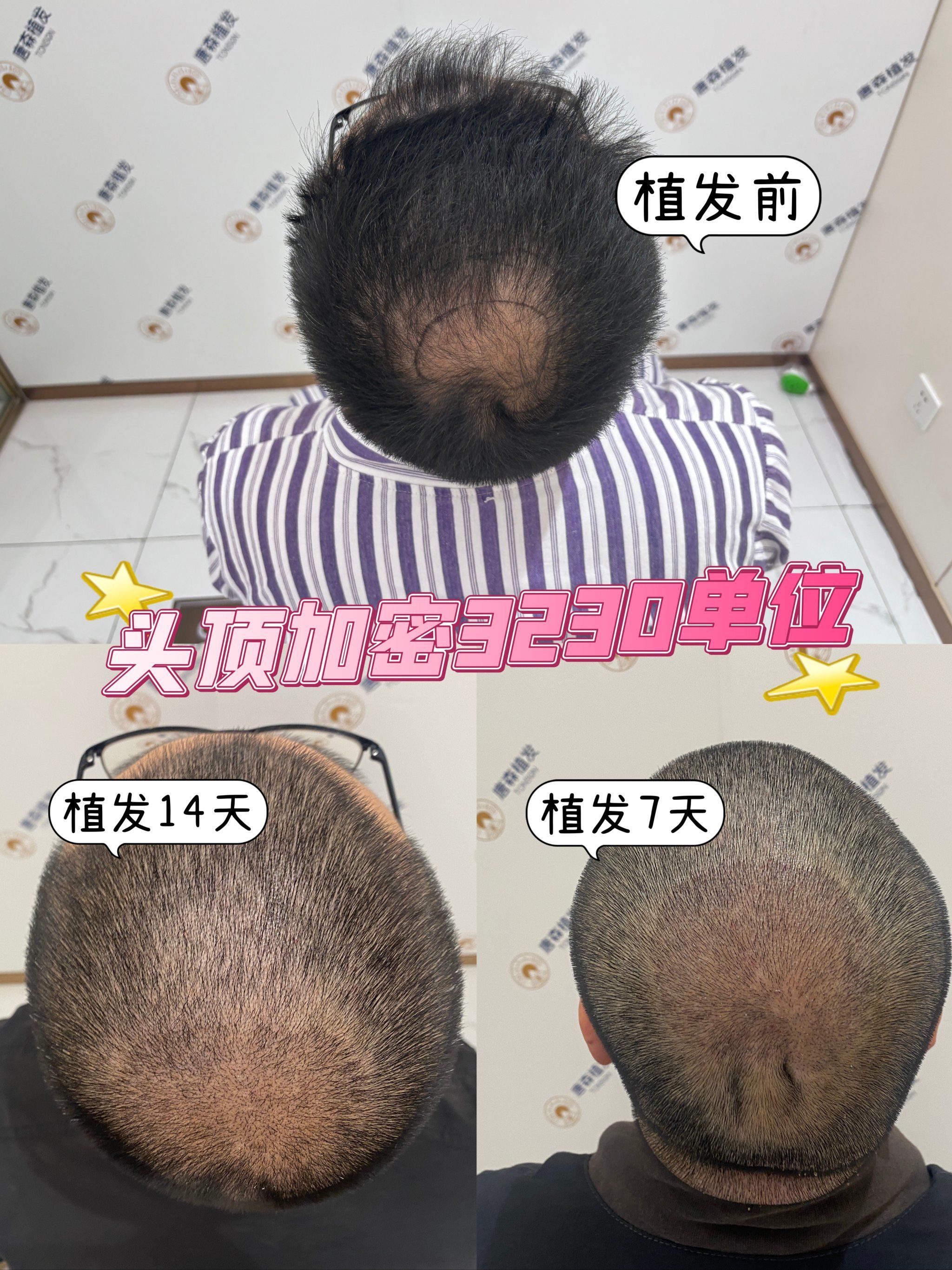给想要植发人的参考,头顶加密3230单位