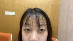 体验后-广州健丽·去眼袋医疗美容机构