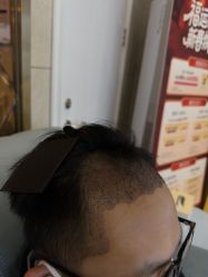 -碧莲盛·不剃发植发
