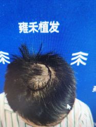 -雍禾植发全国连锁