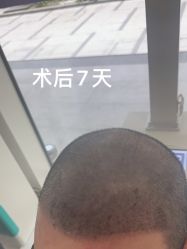 体验后-北京雍禾植发医院