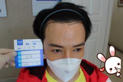 -大麦微针植发丨全国连锁