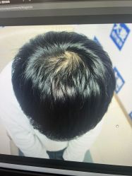-大麦微针植发丨全国连锁