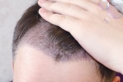 -大麦微针植发丨全国连锁