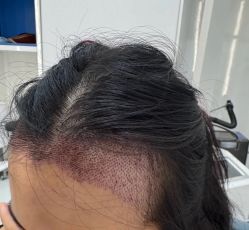 -大麦微针植发全国连锁