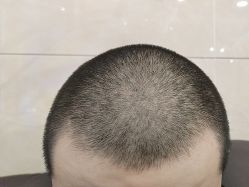 -碧莲盛·不剃发植发