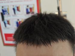 -碧莲盛·不剃发植发