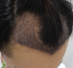 -大麦微针植发丨全国连锁