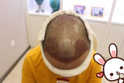 点击看大图 -大麦微针植发丨全国连锁