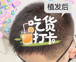 -大麦微针植发全国连锁