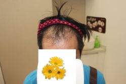 -大麦微针植发丨全国连锁