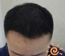 -大麦微针植发丨全国连锁