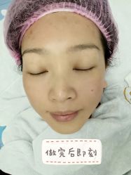 体验后-叶美人医疗美容