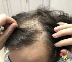点击看大图 -大麦微针植发全国连锁