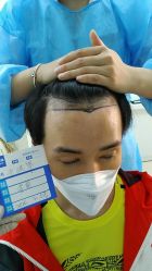 -大麦微针植发丨全国连锁