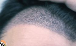 -大麦微针植发丨全国连锁