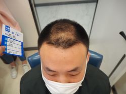 -大麦微针植发丨全国连锁