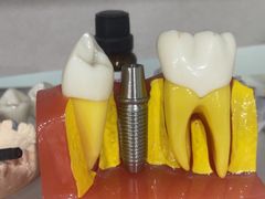 -上海仁爱医院口腔科 · 种植