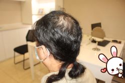 -大麦微针植发丨全国连锁