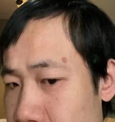 点击看大图 -北京美痣堂古方祛痣斑疣瘊